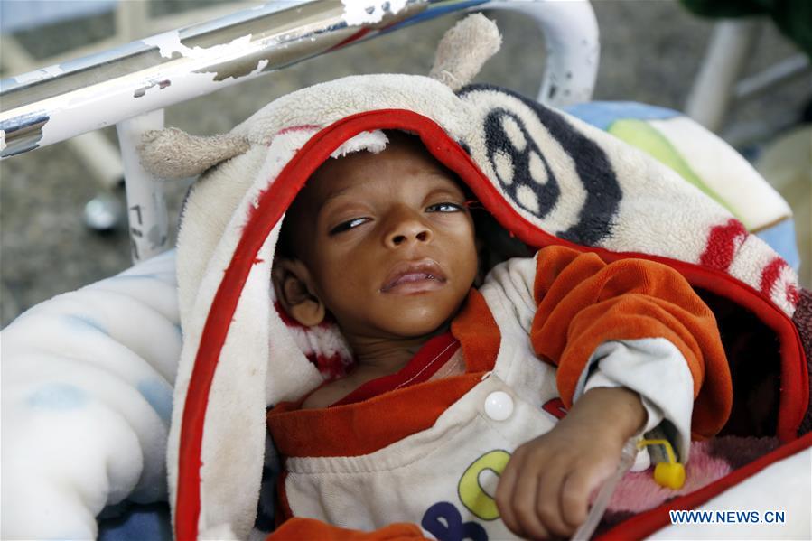 YEMEN-SANAA-CHILDREN-MALNUTRITION